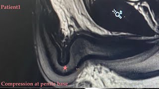 My Hard Flaccid Story (Symptoms, Timeline, Recovery)