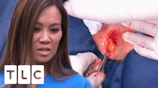 Dr. Lee ANGRY As Patient Performs Surgery On Themselves! | Dr. Pimple Popper | UNCENSORED | 18+