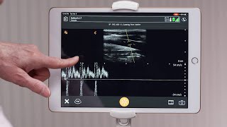 Clarius Feature: Pulsed-Wave Doppler Mode