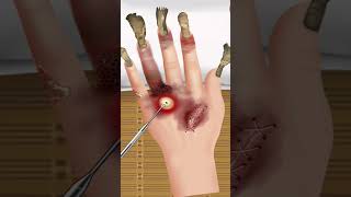ASMR Treatment of Hand infection and removal of maggot worm #asmr #animation #brainasmr