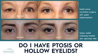 Eyelid Ptosis, and Hollow Upper Eyelids - Different Causes, and Treatments