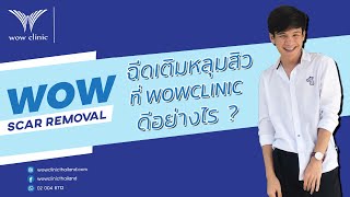 WOW Clinic | ปัญหาหลุมสิว ที่เป็นมากว่า 10 ปี มาดีขึ้นได้ที่ WOW Clinic