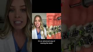 TAD for braces. #braces #orthodontist #dentist
