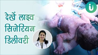 देखें सिजेरियन डिलीवरी कैसे होती है वो भी लाइव - C-section, cesarean delivery live in hindi