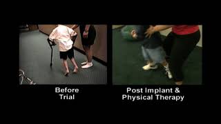 Dr. Georgios Matis - Neuromodulation - Cerebral palsy before \u0026 after intrathecal baclofen therapy