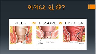 ભગંદર શું છે? ભગંદર કેવી રીતે થાય છે?