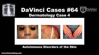 Autoimmune Disorders of the Skin [#DaVinciCases Dermatology Case 4]