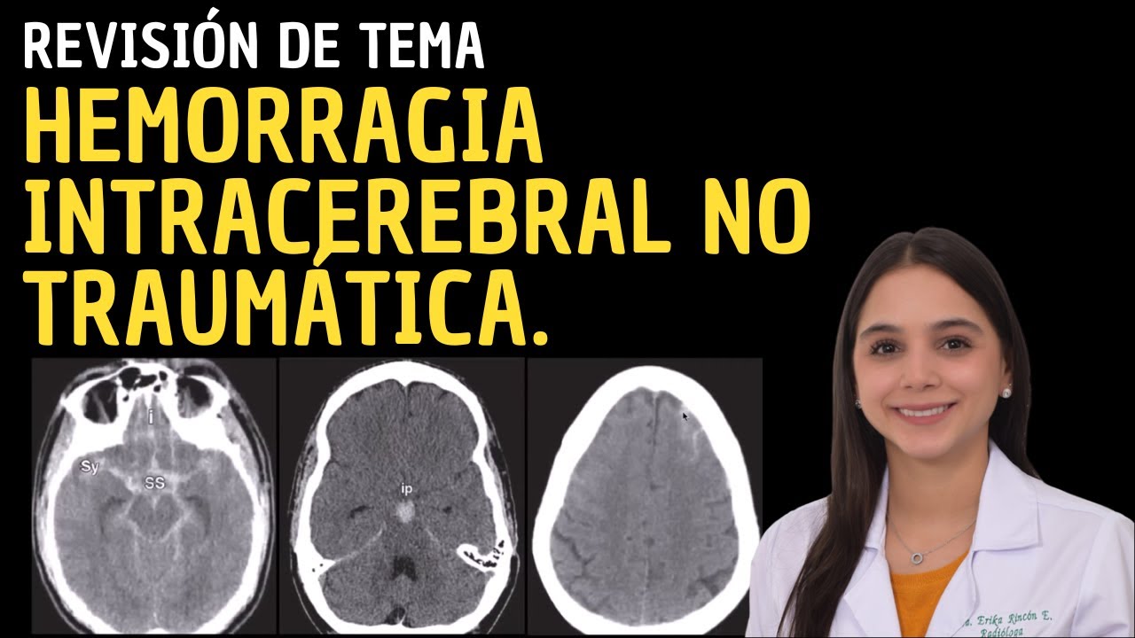 Revisión De Tema 44: Hemorragia Intracerebral No Traumática. - YouTube