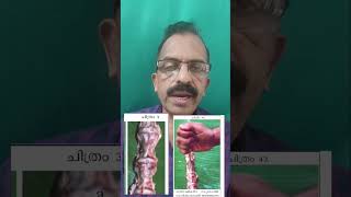 Disc Prolapse-Back pain-2