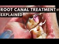 ROOT CANAL TREATMENT - Everything You Need To Know