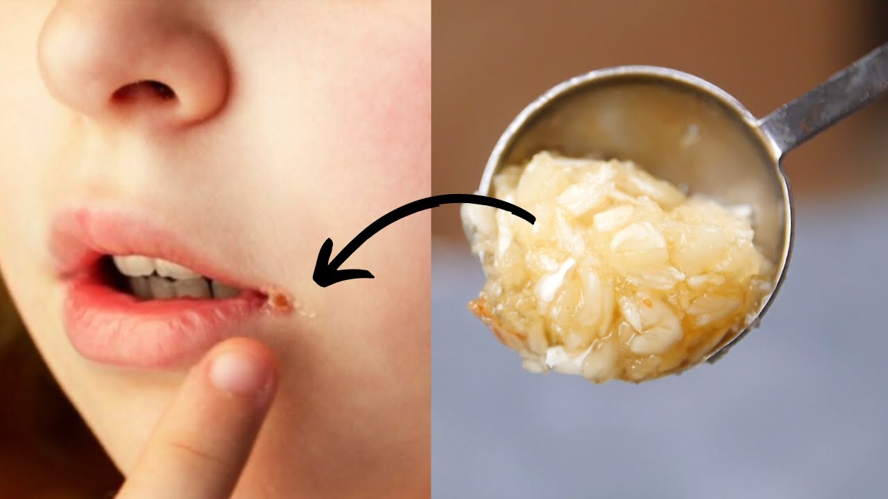 How To Heal Cracked Lip Corners Fast - Get Rid Of Angular Cheilitis ...