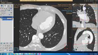 Philips portal CT Viewer \u0026 cardiac CT viewer introduction 50 minutes