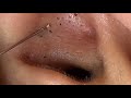 ear blackheads