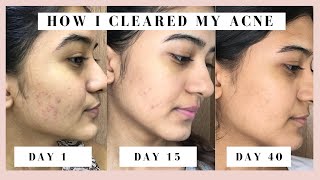 HOW I CLEARED MY ACNE \u0026 DARK SPOTS | My Skin Journey | Tamil