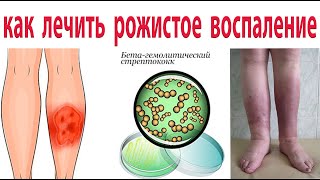 Как вылечить рожистое воспаление без рецидивов. Эффективность 99% !!!!!!