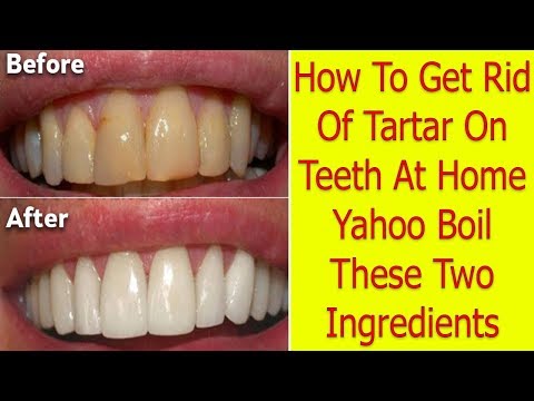 How To Get Rid Of Tartar On Teeth At Home Yahoo | Boil These Two Ingredients How To Get Rid Of Tartar On Teeth At Home Yahoo | Boil These Two Ingredients