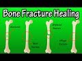 How Does A Bone Break Heal - Bone Fracture Healing Process How Does A Bone Break Heal - Bone Fracture Healing Process