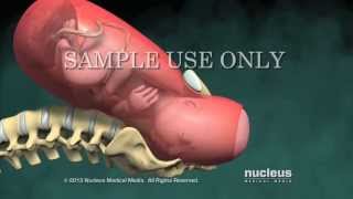 Normal Vaginal Birth with Cervical Effacement and Dilatation (Dilation)