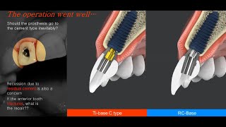 MegaGen RcBase Abutment