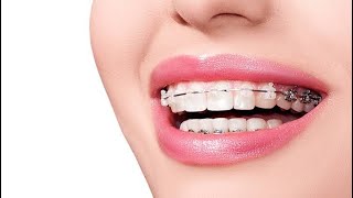 Orthodontic Treatment | Braces Treatment | Clip Treatment | Clear Aligners | Smile Correction