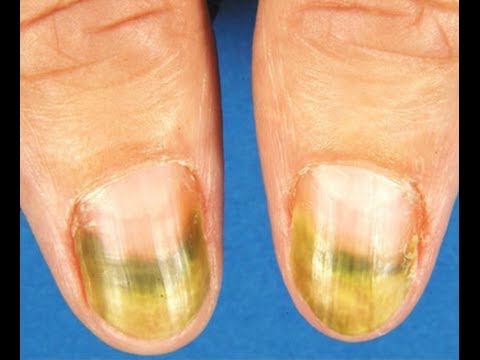 Green Mold Under Toenail - Nail Ftempo