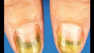 Green Nails [DermTV.com Epi #529]