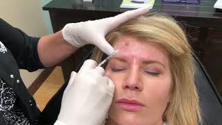 Allergan - Botox Injections