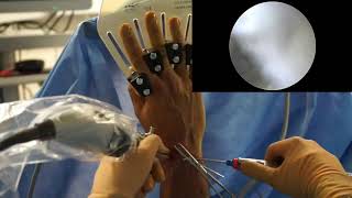 All Dorsal Arthroscopic Ligamentoplasty ADAL in Scapholunate Instability Management