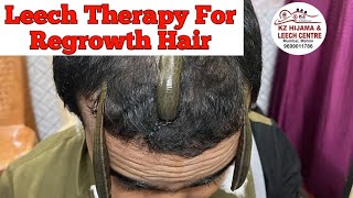 Leech therapy for regrowth hair ( जोंक थेरेपी के फायदे ) Leech Therapy Benefits  in Hindi #leech #kz