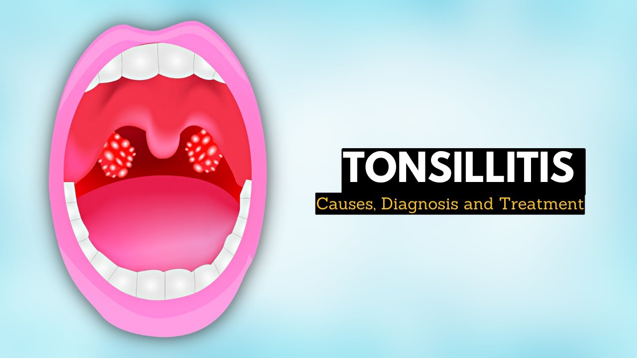 Tonsillitis, Causes, Signs And Symptoms, Diagnosis And Treatment. - YouTube