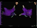 Left Atrial Flutter High density Mapping using HD Grid Propagation Map 1