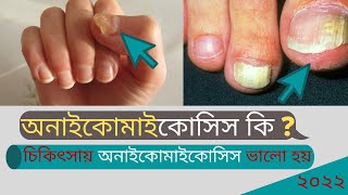 Onychomycosis | Symptoms | Nail Infections I Symptoms, Treatment. #Onychomycosis Bangla