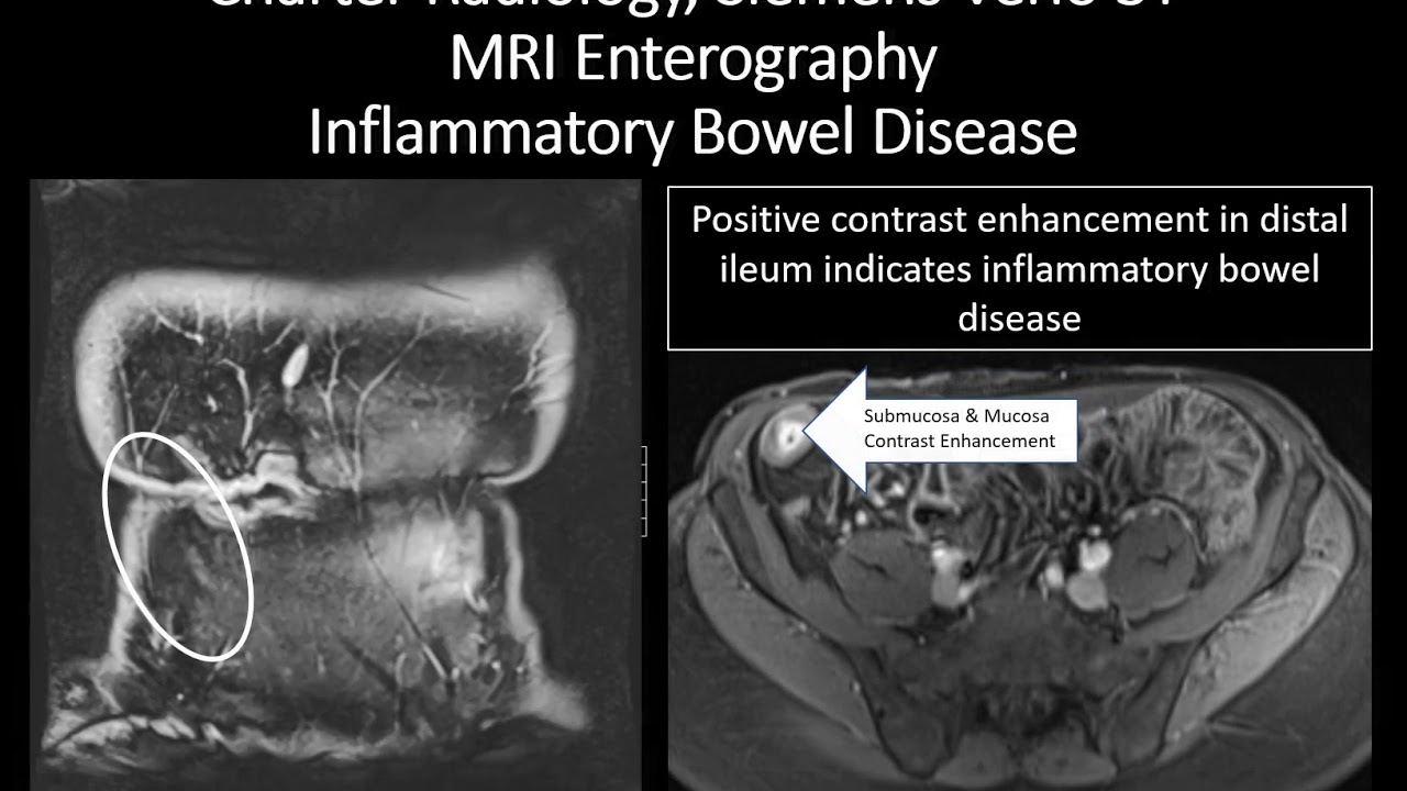 MRI Enterography, Inflammatory Bowel Disease - YouTube