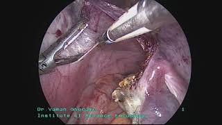 TLH for large bulky fibroid uterus with in situ morcellation voice