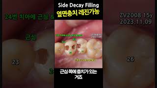 옆면충치 레진가능. 인레이, 크라운 하면 치아손사이 크니 금지 Side Decay filling 옆면충치 99_2023_11_23