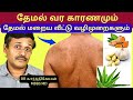 தேமல் மறைய என்ன செய்வது? | White patches on face skin home remedies | treatment for tinea