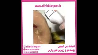 هایفوتراپی معجزه جوانسازی و لیفت صورت/هزینه و مزایا