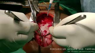 Cardiac Tamponade - Surgical drainage and repair