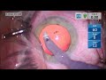 Managing Reverse Pupillary Block in a High Myope, Toric IOL