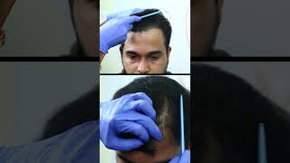 Hair Transplant Results After 6 Months