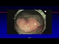 Identification of Adenomas