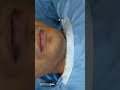 Before and After extended Genioplasty - Best Jaw Surgery in India