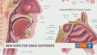 New study offers new hope for people suffering with chronic sinusitis
