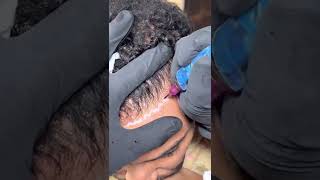 Scalp-Micropigmentation the complete first session!