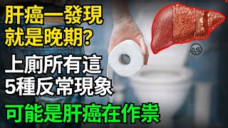 肝癌一發現就是晚期？醫生提醒：上廁所有這5種反常現象，可能是肝癌在作祟