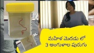 మహిళ మెదడు లో 3 అంగుళాల పురుగు/Telugu/youtube channel/@thingsiknow6454