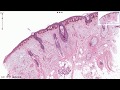 Solar Lentigo - Histopathology