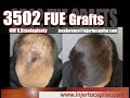 9305FUE Grafts.NWV.Scars due to Cranioplasty. 3steps strategy. Shaved. Injertocapilar.com.2102/2017.