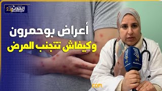 فاس..اعراض بوحمرون وكفاش تعرف انك مصاب وها كفاش تتجنب العدوى