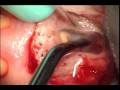 dr. jason deblinger root canal surgery microscopic apicoectomy lower anterior